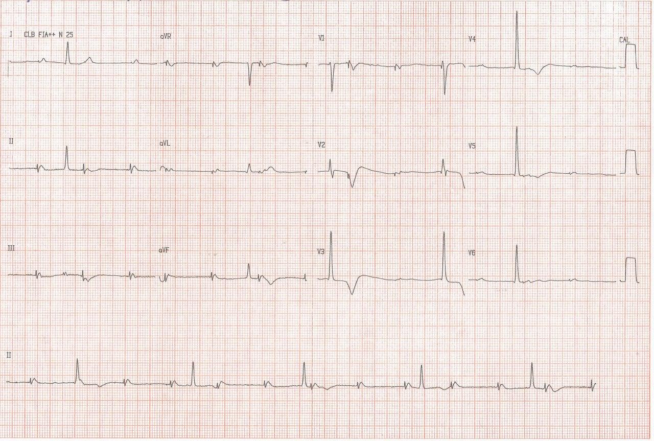 Implante de MP VVI con desplazamiento del catéter a AD