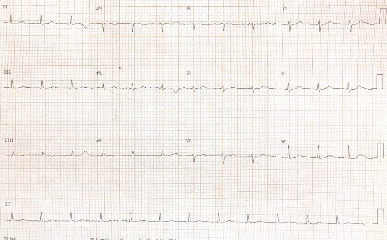 Mujer de 57 años con disnea, astenia, edemas en MI que presenta RIVA y derrame pericárdico por severo hipotiroidismo que es tratado y posterior hallazgo de hipopotasemia