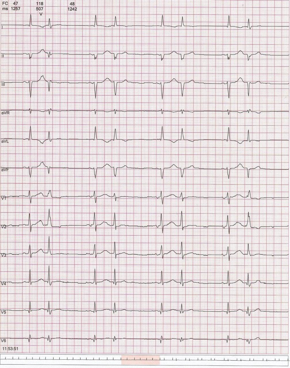 Mujer de 61 años, 15 días a posteriori de cirugía correctora sobre válvula mitral que presenta mareos