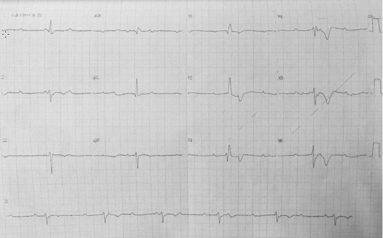 Paciente de 79 años con angor de reciente comienzo que desarrolla BAVC