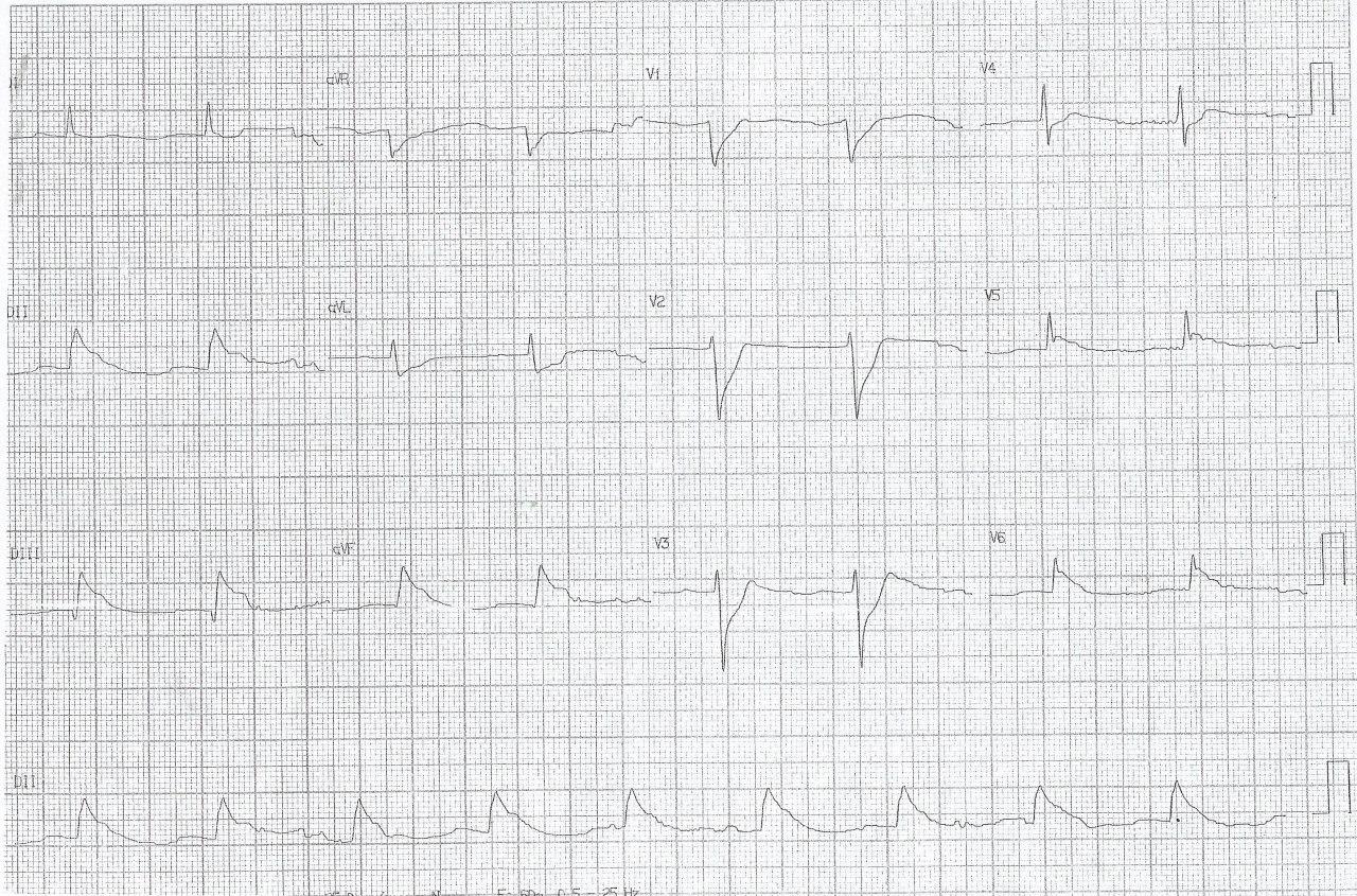 Hombre de 53 años que presenta episodio de angor de reposo seguido de FV que logra ser revertida observándose presencia de onda lambda determinada por lesión con trombo seguido de espasmo de CD que es tratado con aspiración y nitratos