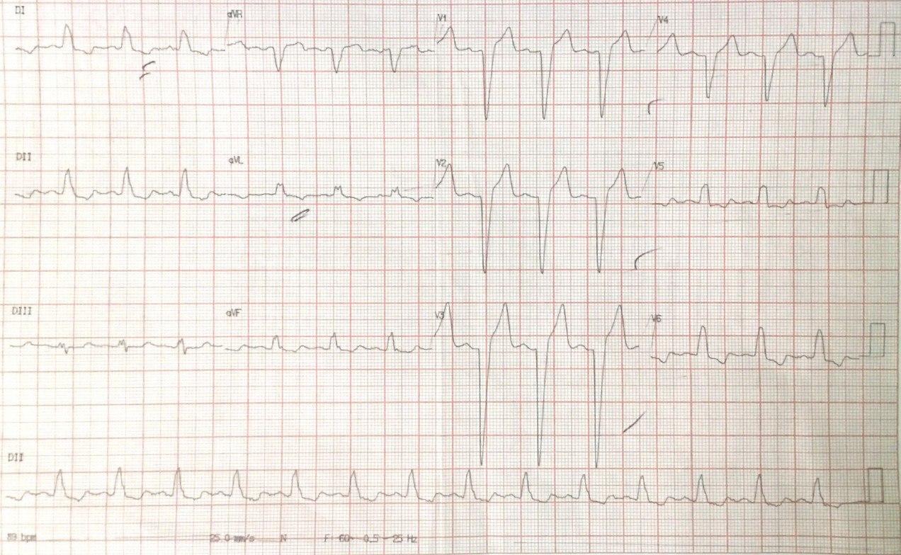 Hombre de 68 años hipertenso y diabético con angor prolongado; en contexto de BCRI, la polaridad de onda T permite descartar Memoria Cardíaca