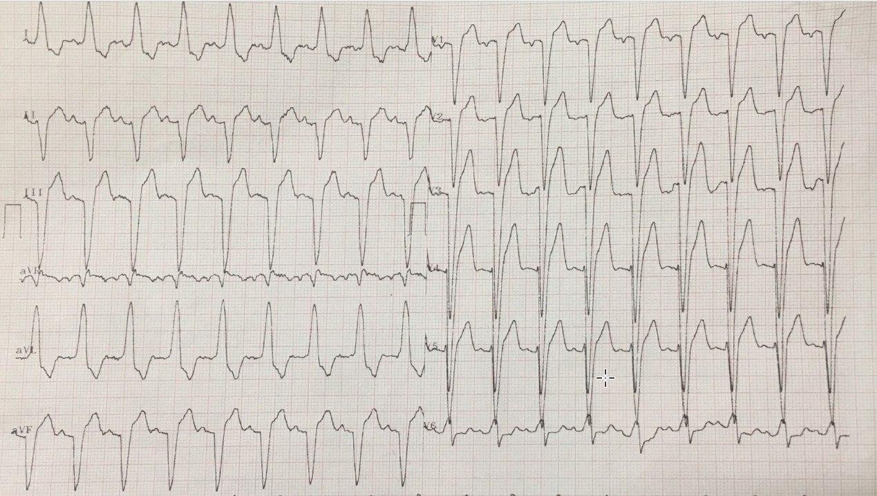 Hombre de 66 años con precordialgia atípica atribuible a BCRI doloroso por disincronía y presencia de ondas T negativas por memoria cardíaca