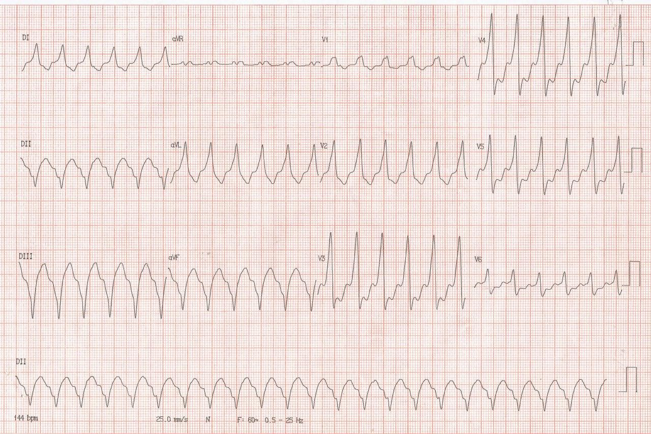 Hombre de 73 años con IC previa que presenta una TV que un nuevo algoritmo identifica como epicárdica