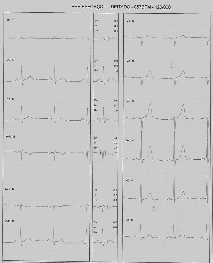 Paciente masculino de 71 años con historia de angor de esfuerzo que desarrolla angor durante PEG atribuible a lesión + espasmo de CD
