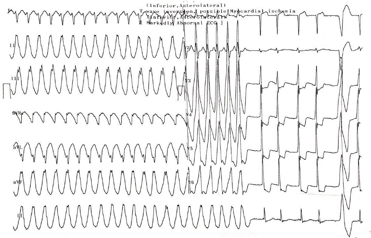 Hombre de 67 años que presenta TV que revierte con amiodarona en presencia de FA y diagnóstico diferencial de vía accesoria