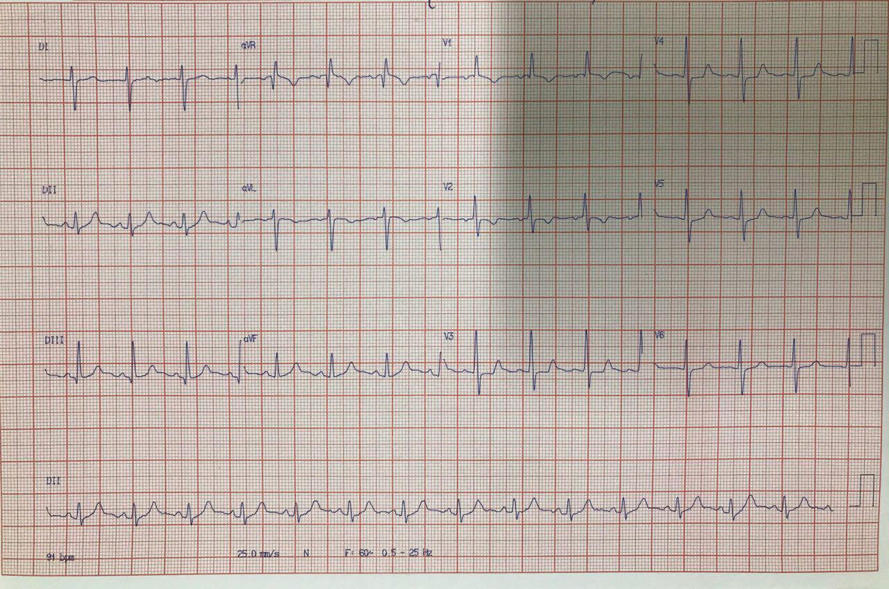 Mujer de 23 años con disnea y cianosis labial por presencia de CIA OS