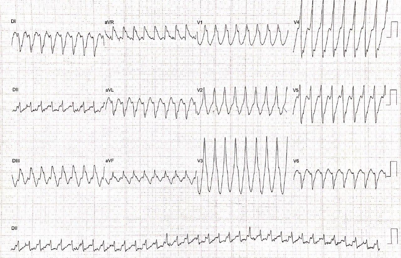 Hombre de 77 años con historia de enfermedad coronaria con implante de stent a DA hace 16 años que presenta angor con presencia de TV fascicular y oclusión de 80% de CD