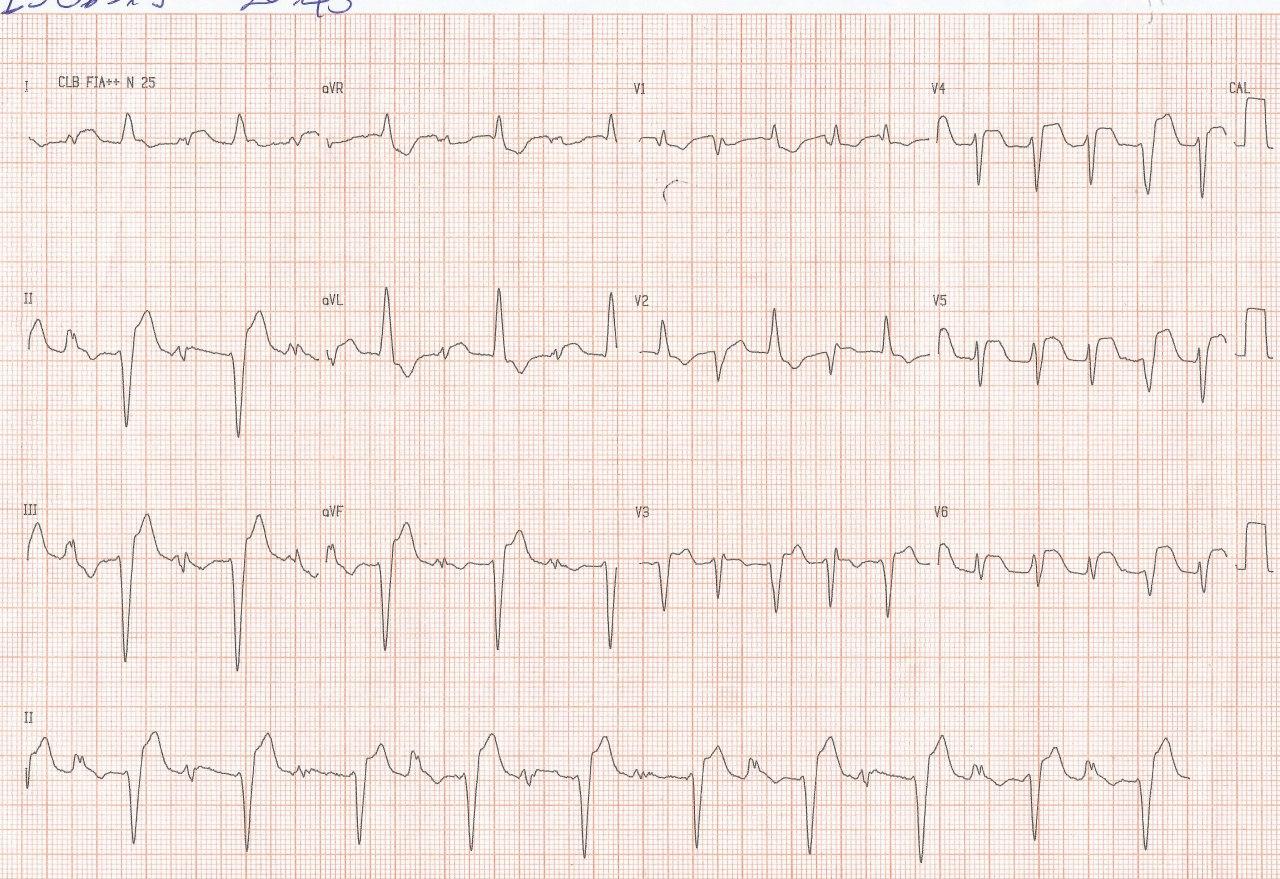 Mujer de 69 años con SCA por trombo en TCI que cursa con TV bidireccional con evolución ominosa