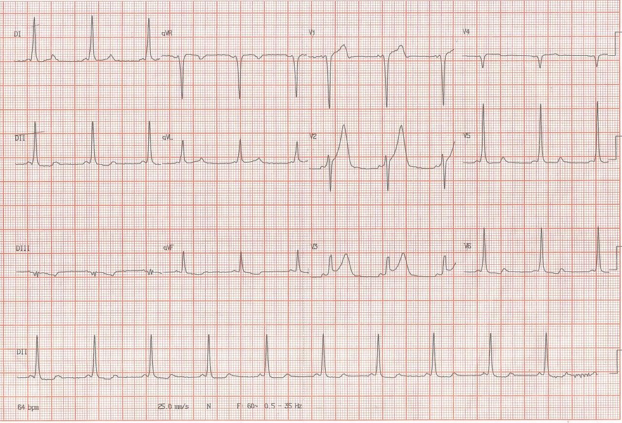 Hombre de 40 años hipertenso con dolor precordial y presencia de WPW que simula isquemia que no fue demostrada