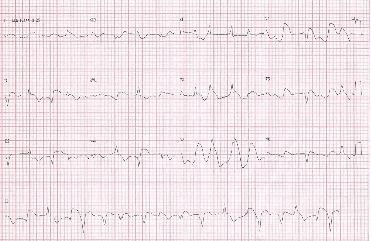 Mujer de 40 años que presenta angor prolongado post stress por sindrome de takotsubo con presencia de ondas lambda que indican mal pronóstico