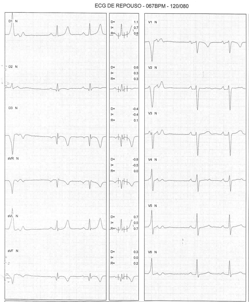 Hombre de 40 años con factores de riesgo y antecedentes de cirugía de revascularización 3 años antes que durante PEG de rutina presenta ritmo idioventricular acelerado originado en rama derecha