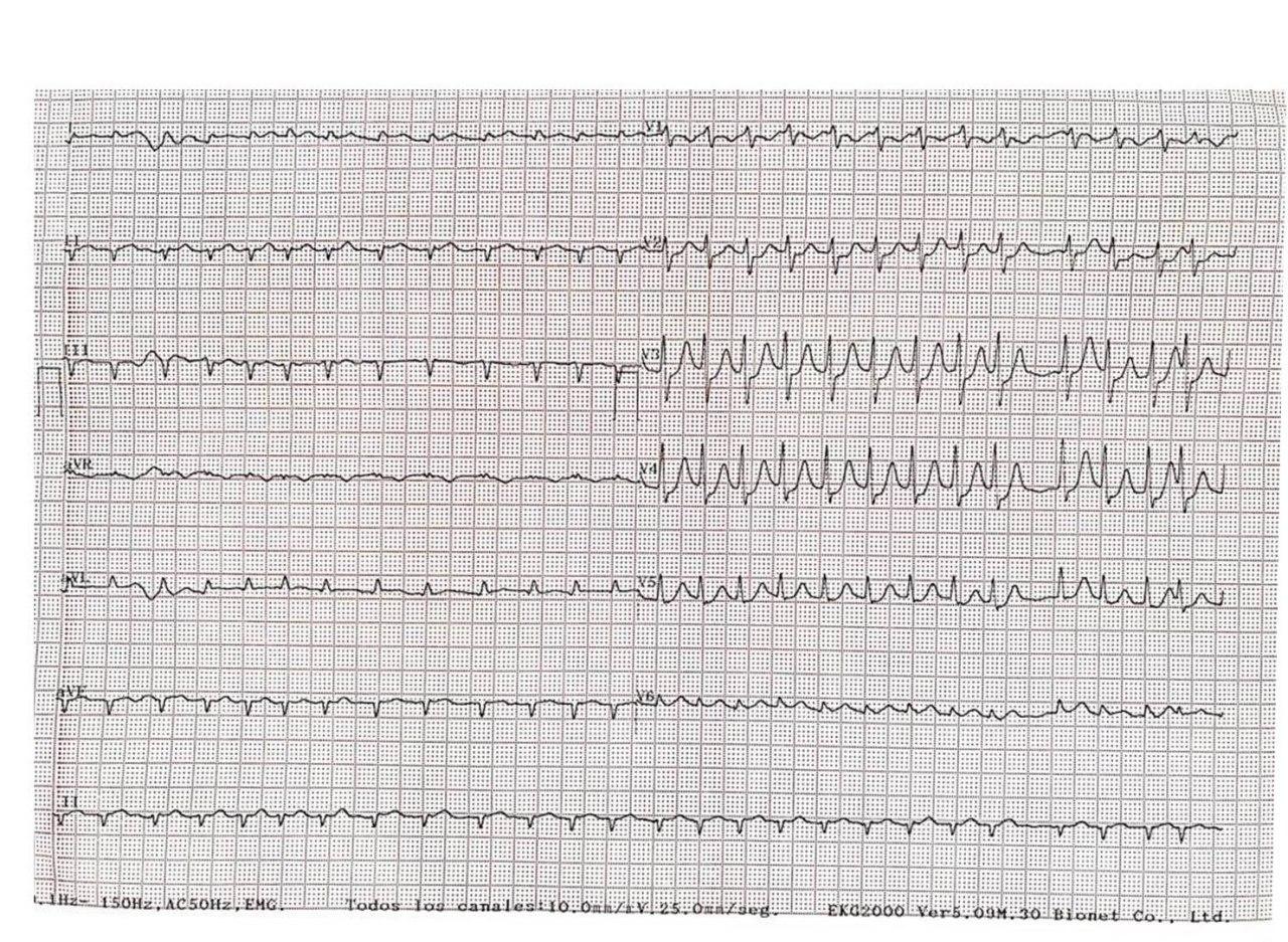 Hombre de 81 años con factores de riesgo que consulta 48 hs después de dolor precordial, que presenta FA de alta respuesta en contexto de SCACEST por compromiso de Cx