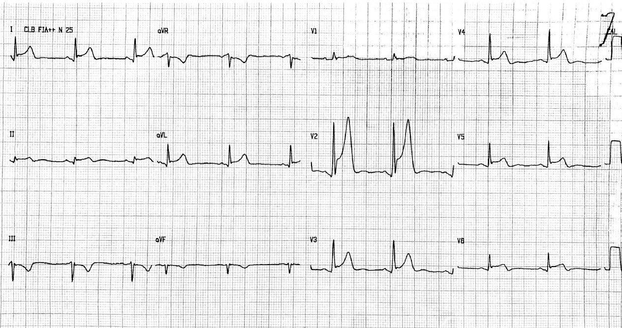 Hombre de 55 años con angor prolongado y sudoración profusa que cursa con SCA con compromiso pericárdico y repolarización precoz por lesión de Cx