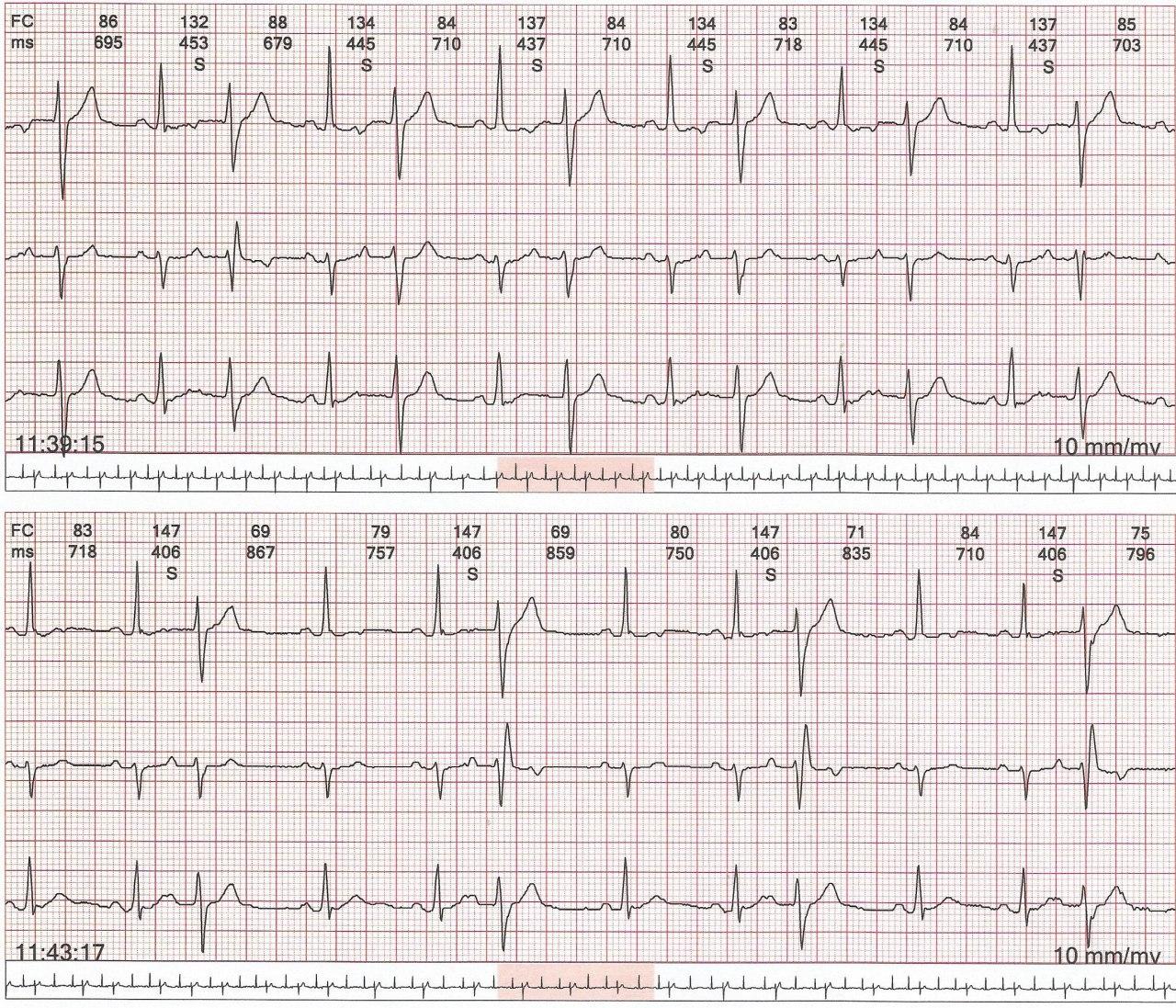 ECG de Holter de paciente con palpitaciones por presencia de extrasistolia auricular primero bi y trigeminada y luego bloqueada dando falsa apariencia de bradicardia sinusal