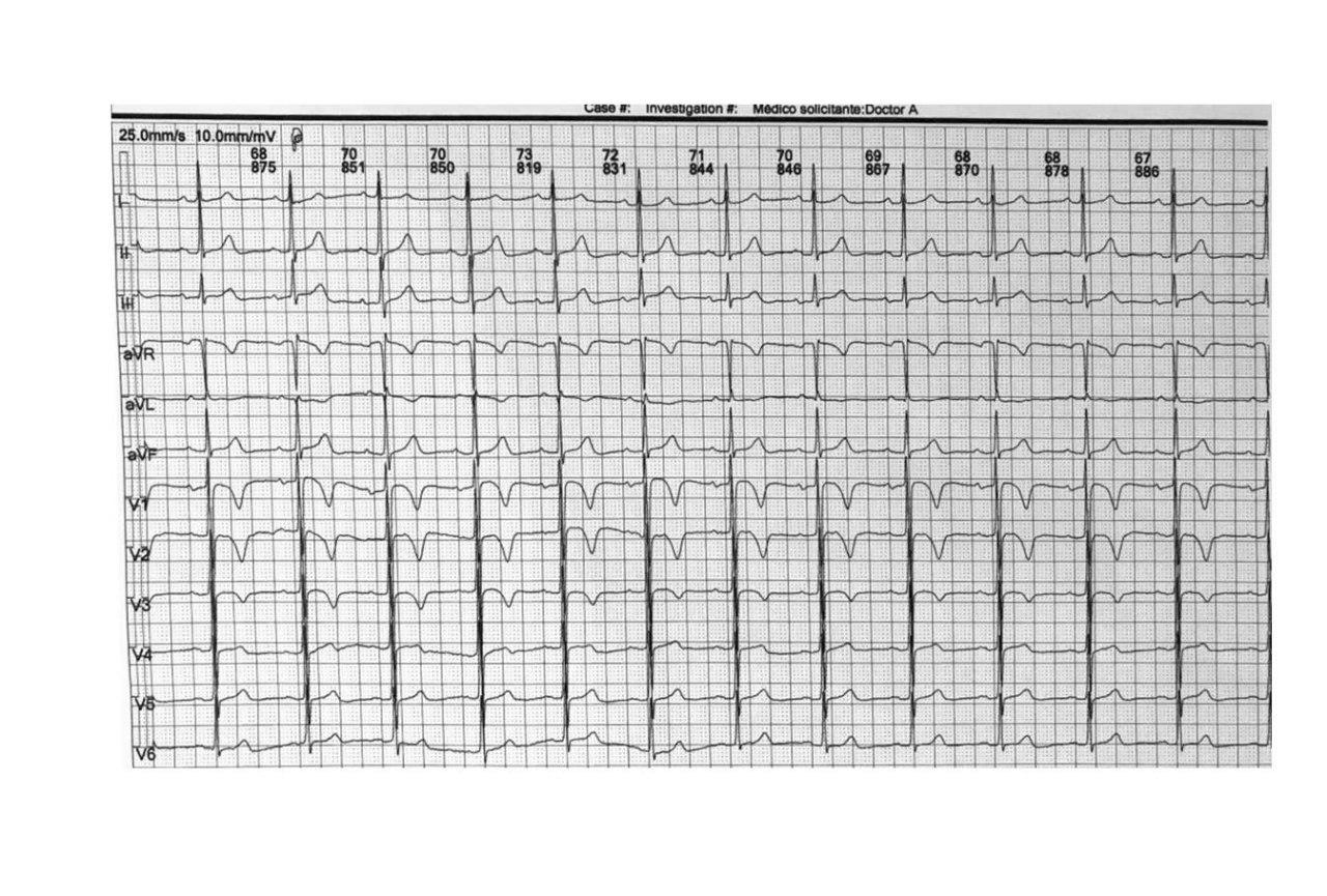 Mujer de 70 años asintomática con mocardiopatía hipertrófica apical