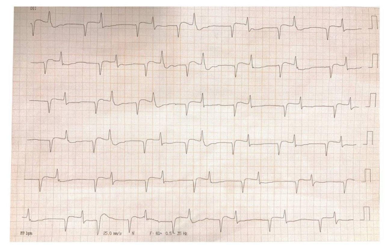 Mujer de 69 años portadora de FA crónica en tratamiento con digital que presenta disnea progresiva y cuadro de intoxicación digitálica