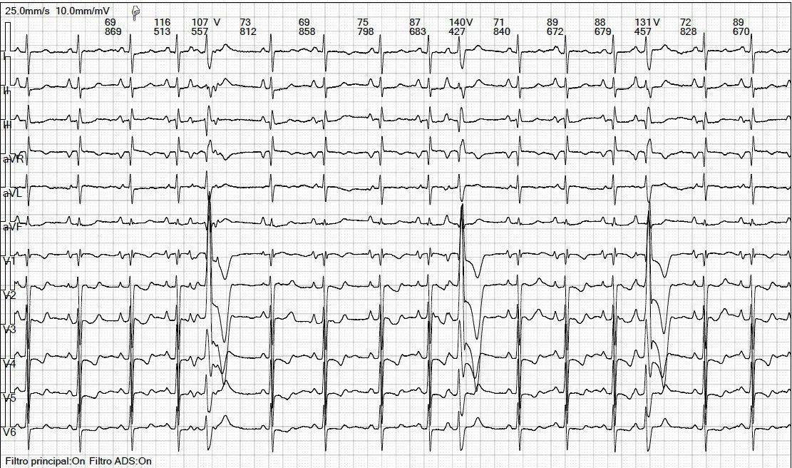 Hombre de 60 años que presenta disnea y cansancio progresivos desde hace 5 meses en el que se detecta presencia de CIA + bicúspide aórtica o canal arterial persistente