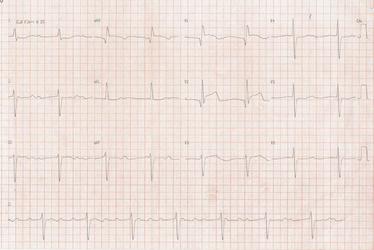 Paciente masculino de 76 años con IAM anterior en 2019 tratado con angioplastia primaria e implante de 4 stents que consulta por nuevo espisodio de angor seguido de FV que es recuperada, saliendo con BAVC por reoclusión con trombo en DA