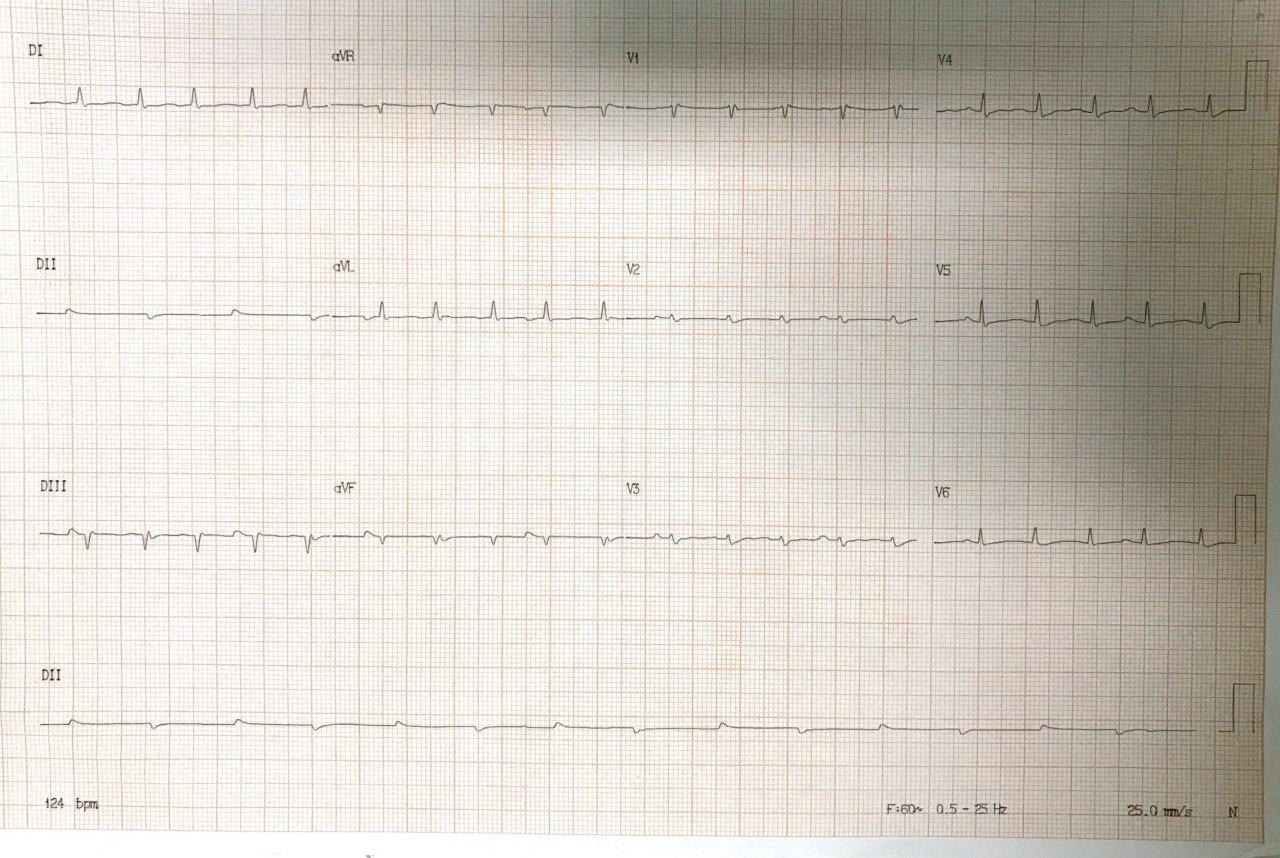 Hombre de 47 años en el postoperatorio inmediato de transplante cardíaco complicado con hemopericardio por lesión coronaria que irriga VD