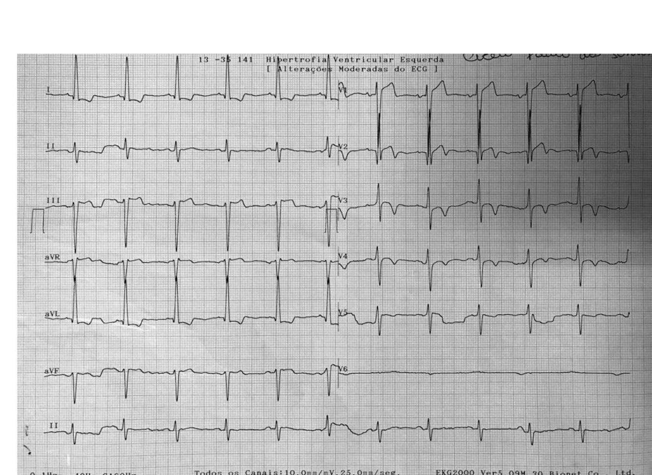 Hombre de 57 años hipertenso y diabético que presenta angor prolongado por SCA por suboclusión de DA