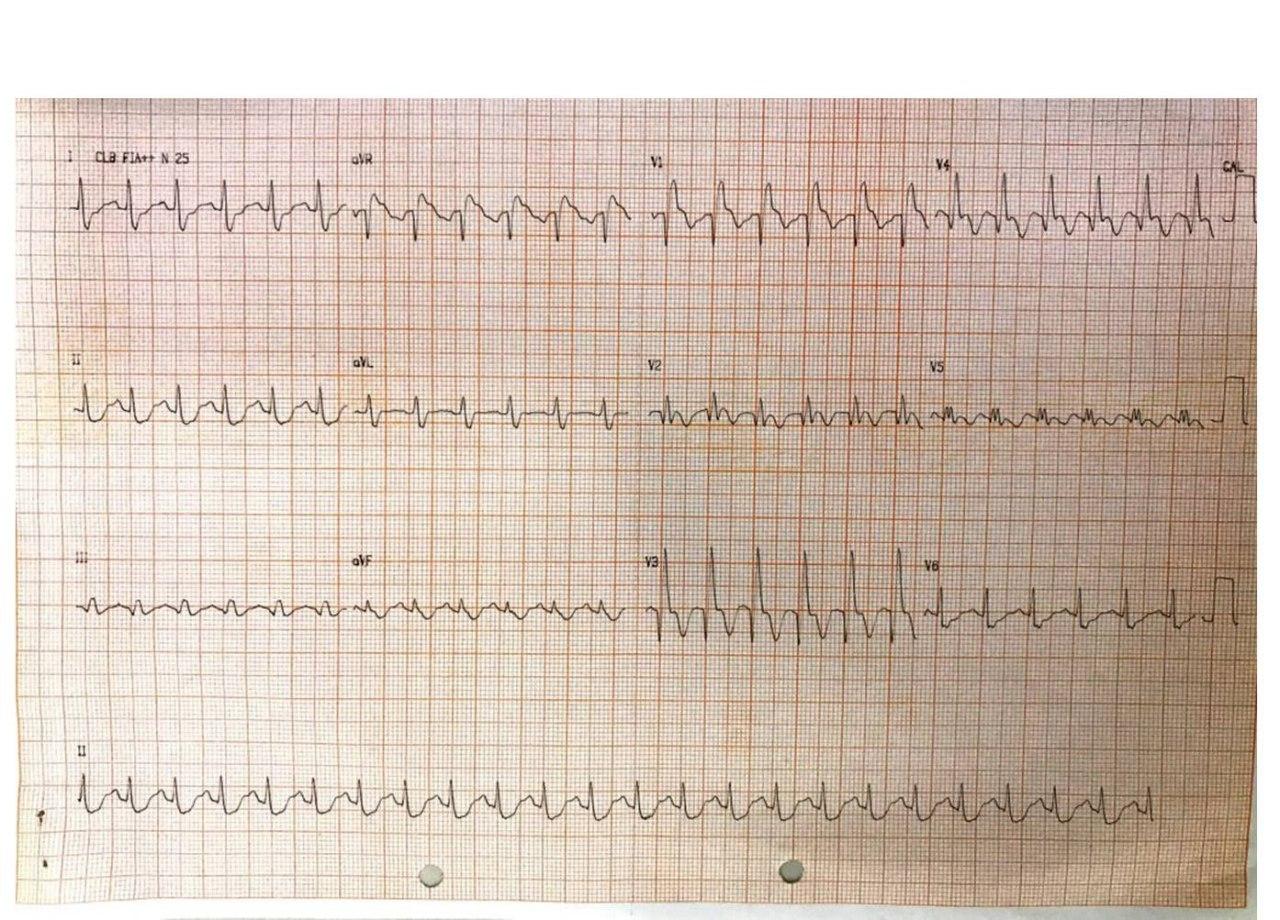 Mujer de 20 años con hipertrigliceridemia familiar que ingresa por angor con aleteo auricular 2:1 que revierte espontáneamente en quién se detecta oclusión de DA y suboclusión de Cx