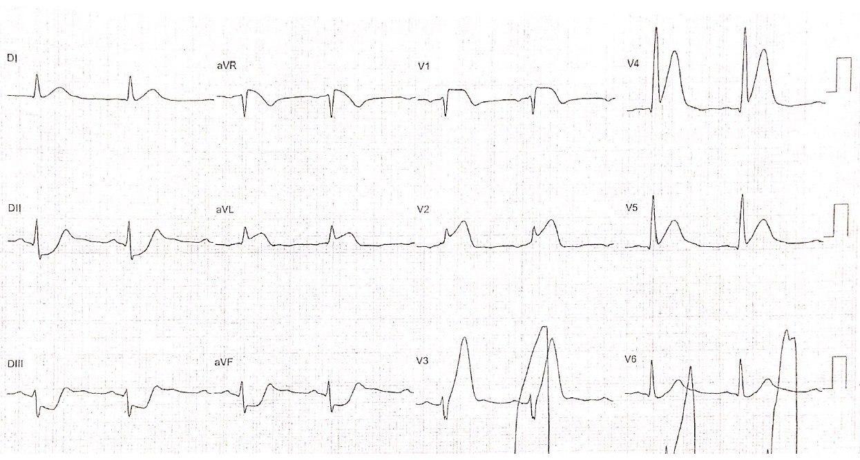 Hombre de 76 años con HTA y dislipemia que presenta cuadro de IAM hiperagudo con desarrollo de ulterior FV por presencia de patrón triangular del QRS-ST-T