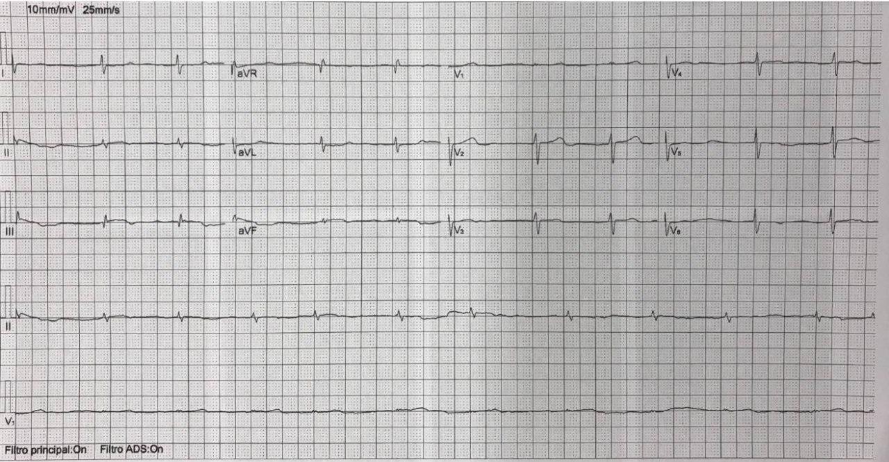 Mujer de 61 años con disnea progresiva y edemas en miembros inferiores, portadora de amiloidosis cardíaca
