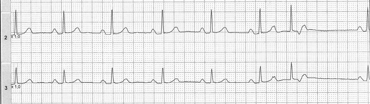 Mujer de 31 años con palpitaciones por presencia de extrasístoles auriculares que desencadenan taquicardia por reentrada