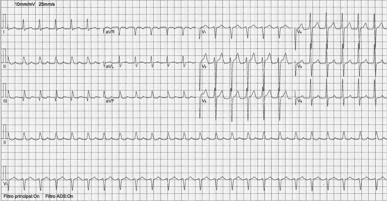 Paciente varón de 49 años con antecedentes de ablación de FA a los 40 años que presenta palpitaciones de esfuerzo correspondientes a aleteo auricular