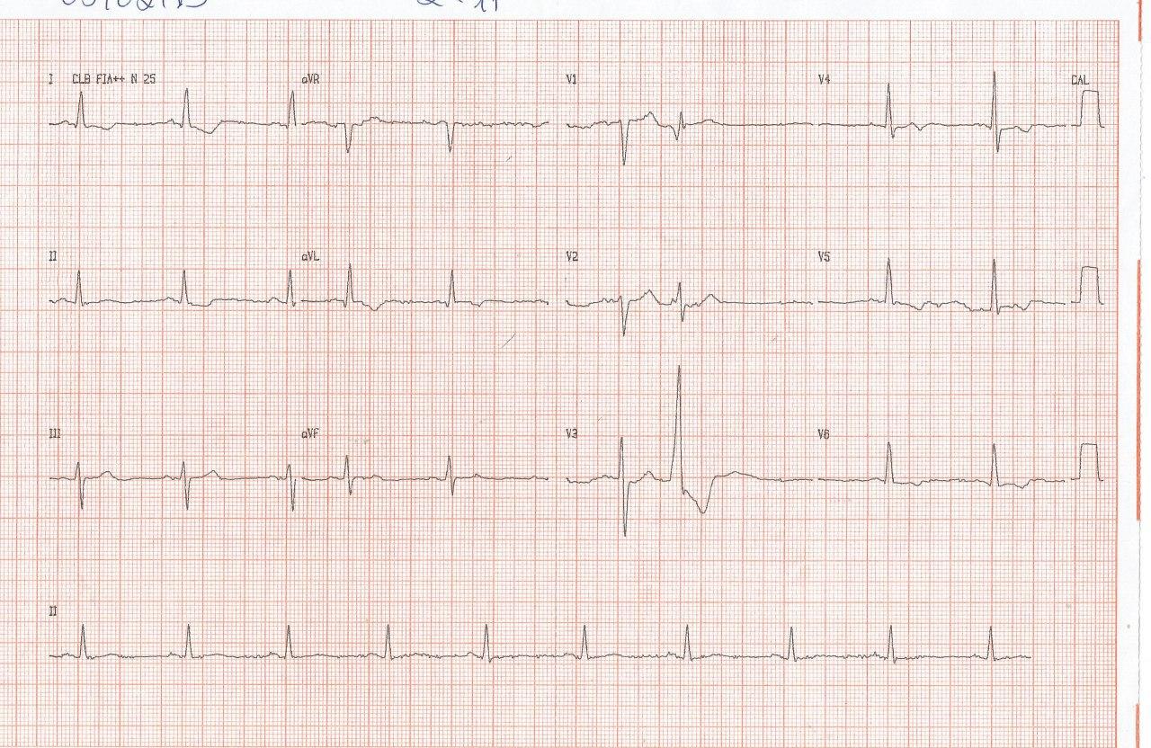 Hombre de 81 años con estenosis aórtica severa a quién se practica TAVI con buena evolución hemodinámica y desarrollo de BCRI