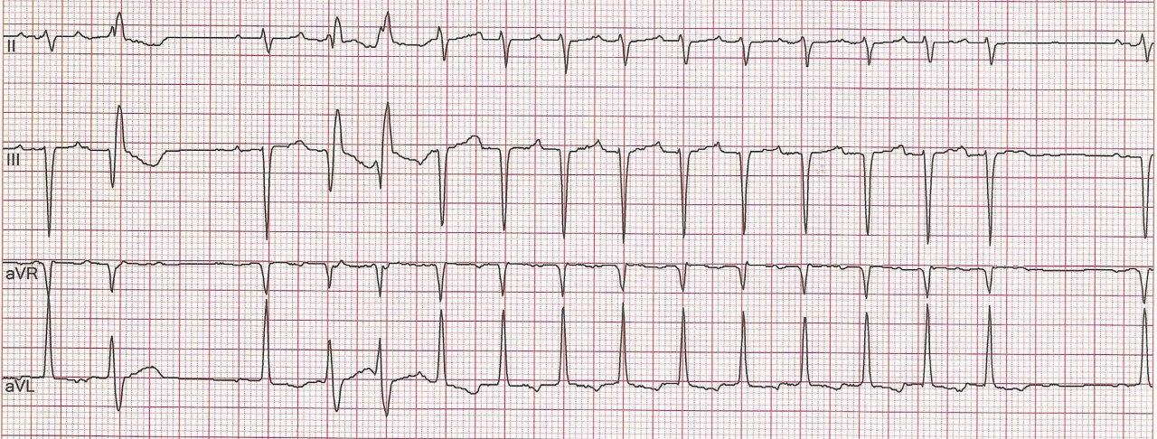 Mujer de 67 años con palpitaciones cuyo Holter muestra episodios de taquicardia que concluyen con un QRS, sin ondas P retroconducidas que permiten confirmar el diagnóstico de Taquicardia Auricular, descartando mecanismo de reentrada