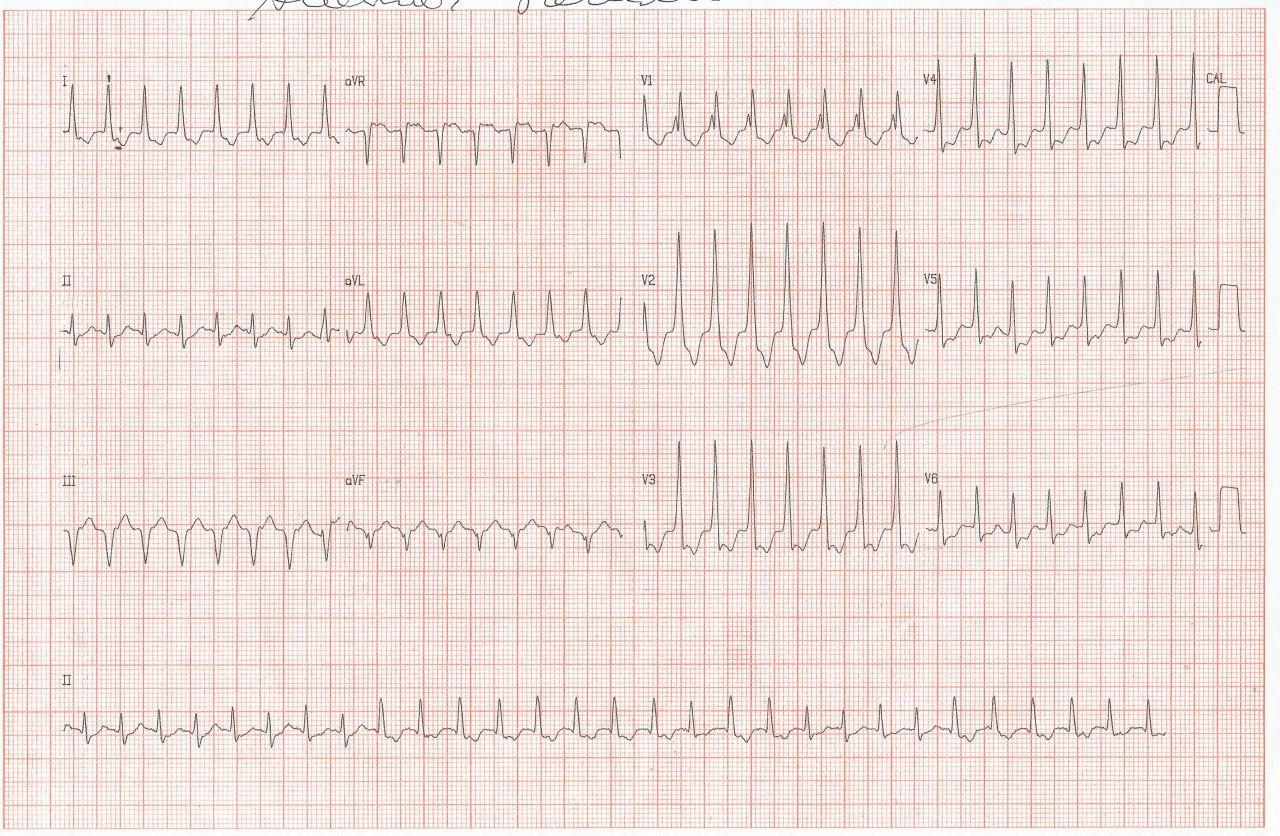 Masculino de 81 años con antecedentes de IAM previo y cirugía de revascularización miocárdica que presenta palpitaciones por taquicardia fascicular posterior de origen isquémico