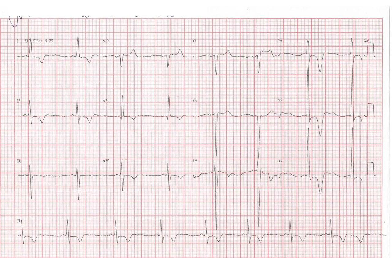 ECGs de 2012 y 2018 de paciente de 69 años con baja tolerancia al esfuerzo y antecedente sincopal hace 15 años que presenta miocardiopatía hipertrófica no obstructiva