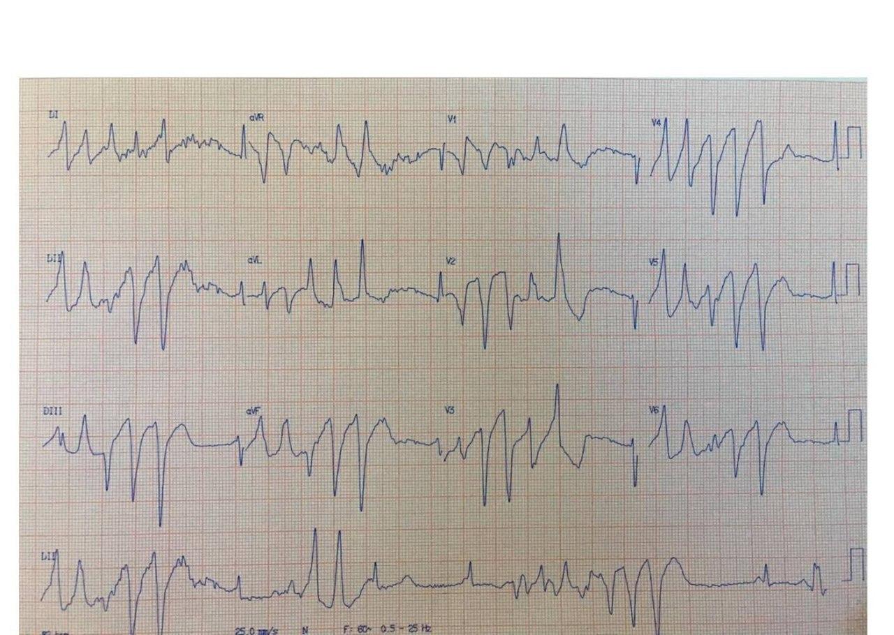 Hombre de 80 años con CA de tiroides tratado con vandetanib (Caprelsa) que presenta episodios sincopales