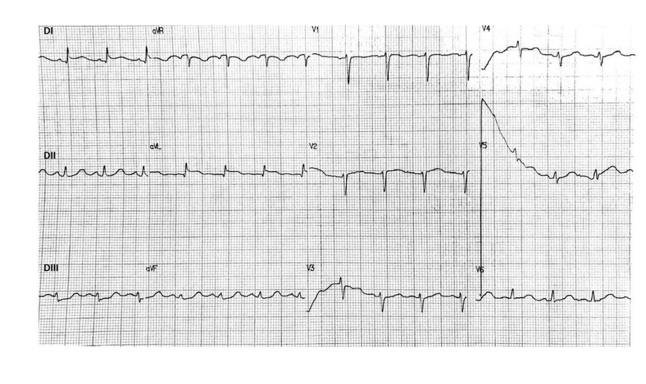 Mujer de 45 años con angor prolongado desencadenado por stress en la que se constata síndrome de takotubo