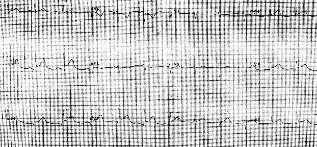 Mujer de 44 años con SCA por embolia distal en arteria DA 3 semanas a posteriori de infección respiratoria