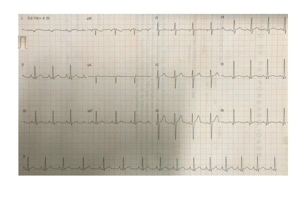 Masculino de 20 años con precordialgia y disnea desde hace 3 semanas atribuibles a miocarditis aguda