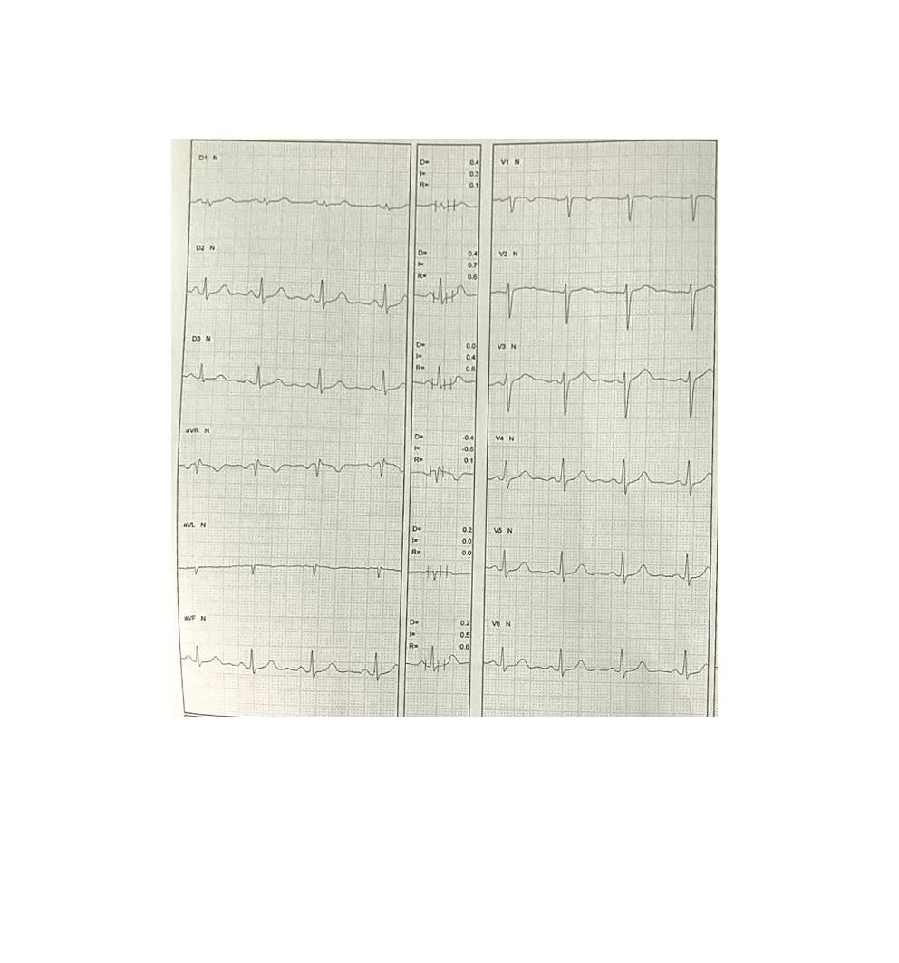 Mujer de 28 años con historia de síncope precedido por palpitaciones vinculadas a estress originadas en taquicardia ventricular catecolaminérgica evidenciada en PEG