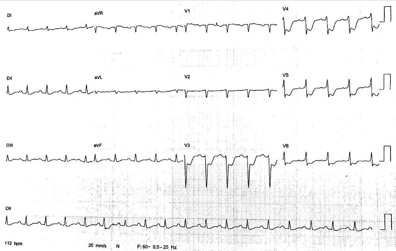 Hombre de 61 años hipertenso que pierde súbitamente la consciencia mientras juega al fútbol constatándose una TV originada en lesión de Cx asociada a enfermedad multivasos
