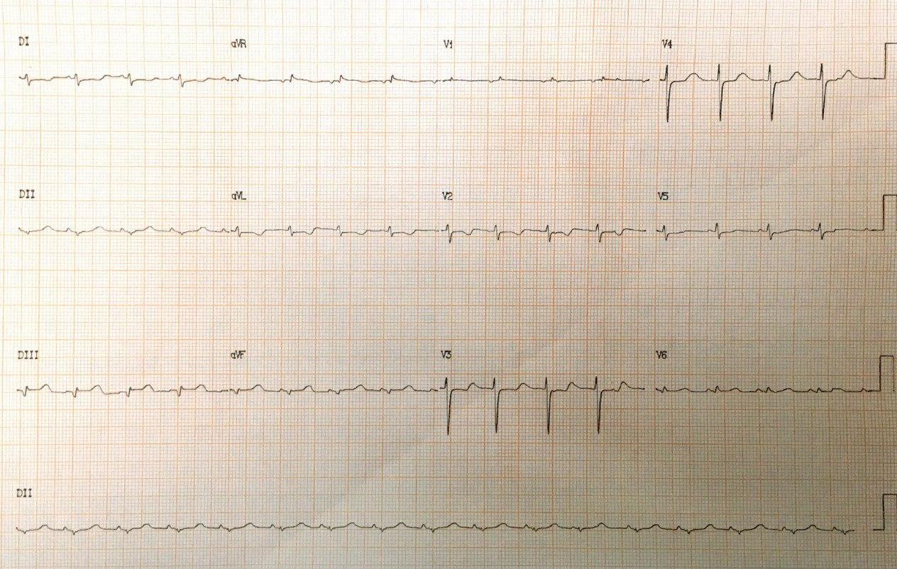 Mujer de 34 años a quién se practica reemplazo valvular mitral con prótesis de St Jude y posterior descompensación por lesión accidental de arteria Cx intraprocedimiento