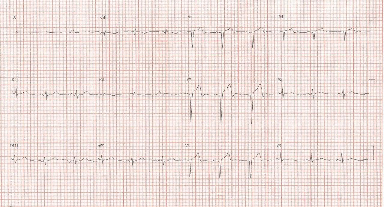 ECG obtenido una hora después de tratamiento de reperfusión que resulta parcial, evidenciado por presencia de ondas T plus-minus, por trombo en DA