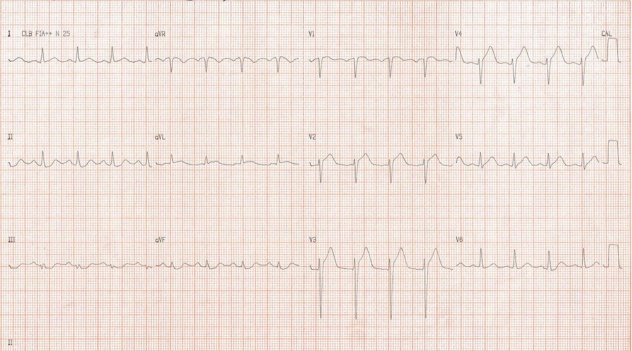 Hombre de 54 años con factores de riesgo que presenta angor prolongado y en quién se detecta obstrucción total de la DA