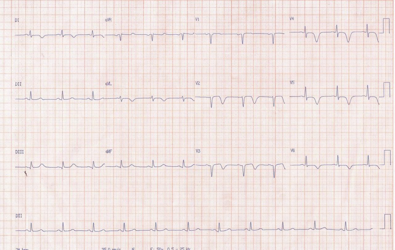 ECG en presencia y ausencia de dolor precordial en mujer de 37 años, fumadora y en tratamiento con anticonceptivos que presenta suboclusión de arteria DA
