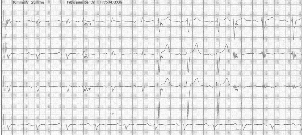 Paciente portador de miocardiopatía dilatada no isquémica que presenta BCRI y eje eléctrico a la derecha por dilatación de cavidades derechas