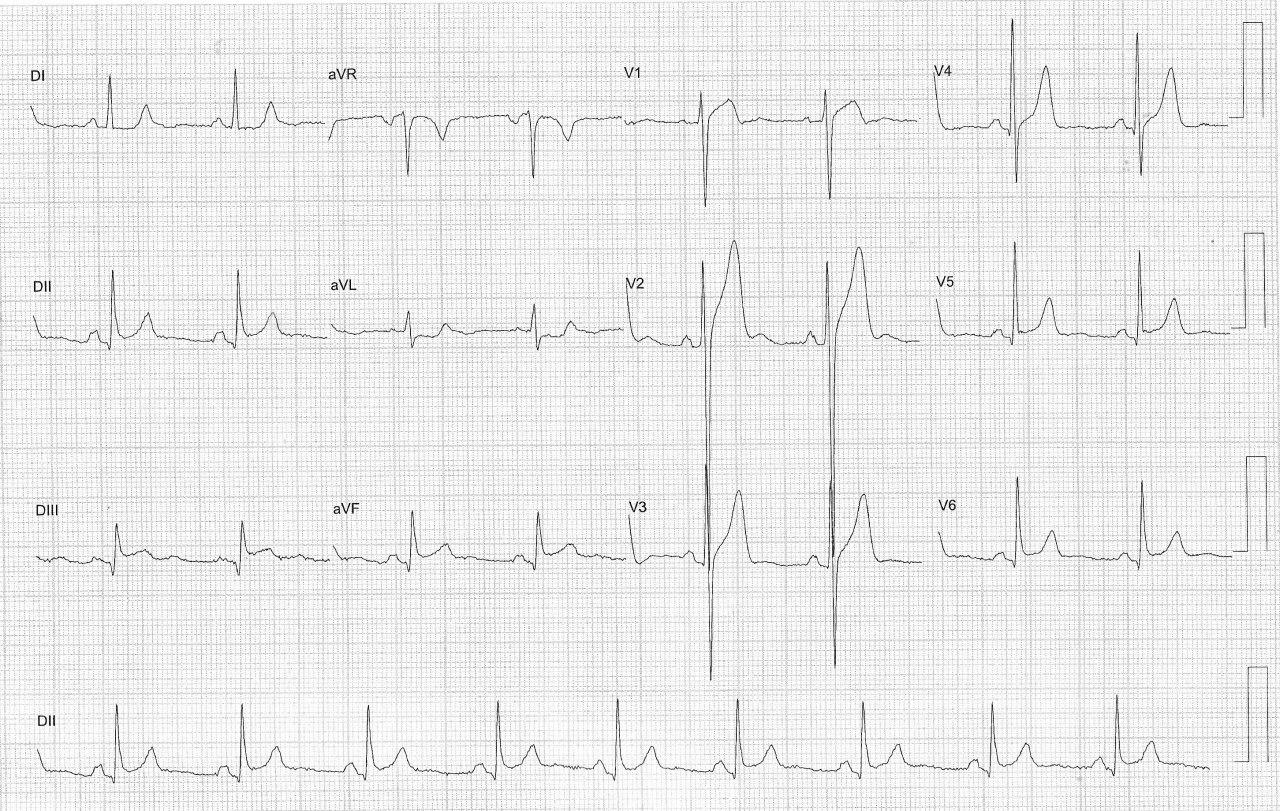 Hombre de 43 años hipertenso y diabético que presenta angor prolongado en quién se constata lesión de DA larga después de ramo septal y arteria diagonal