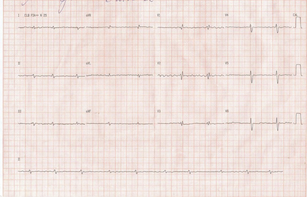 Mujer de 45 años con disnea, edemas y dolor abdominal que presenta aurículas dilatadas y ambos ventrículos normales por presencia de una miocardiopatía restrictiva