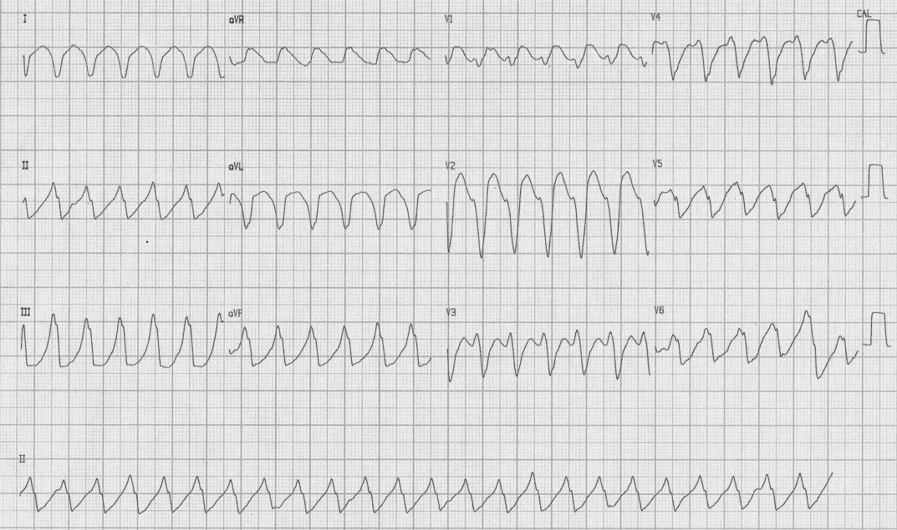 Mujer de 59 años portadora de enfermedad de Chagas y MP bicameral que presenta taquicardia mediada por marcapasos que es revertida constatándose normal funcionamiento del dispositivo