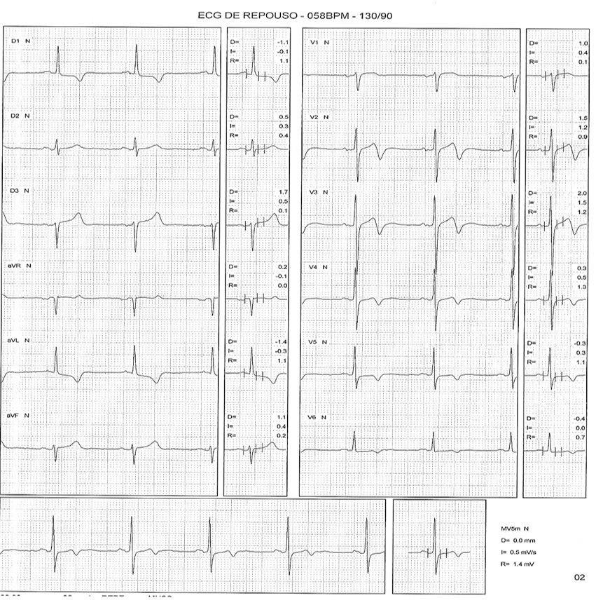 Hombre asintomático de 69 años con dislipemia y antecedentes familiares de enfermedad coronaria portador de miocardiopatía hipertrófica que presenta pseudonormalización de ondas T durante PEG