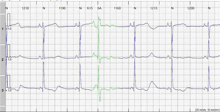 Holter de paciente toroidectomizado por CA de tiroides que manifiesta cansancio y palpitaciones detectándose hipotiroidismo e hipocalcemia